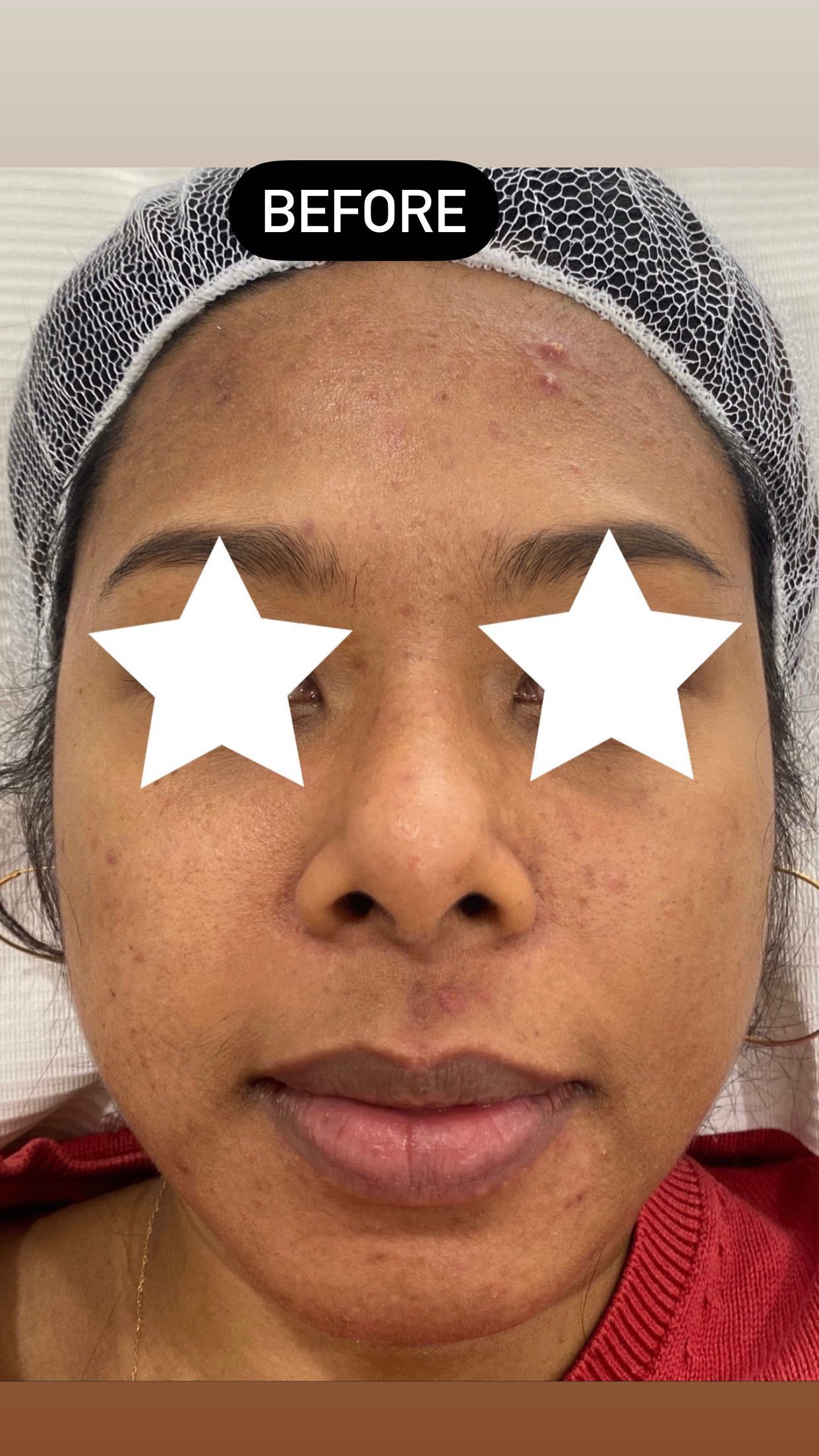 Glass Skin Professional Peel Kit
