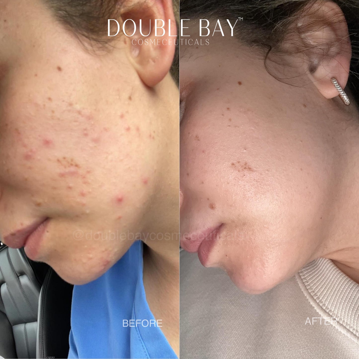 Beginner Glass Skin Bundle- Dry Skin Type - Full Size
