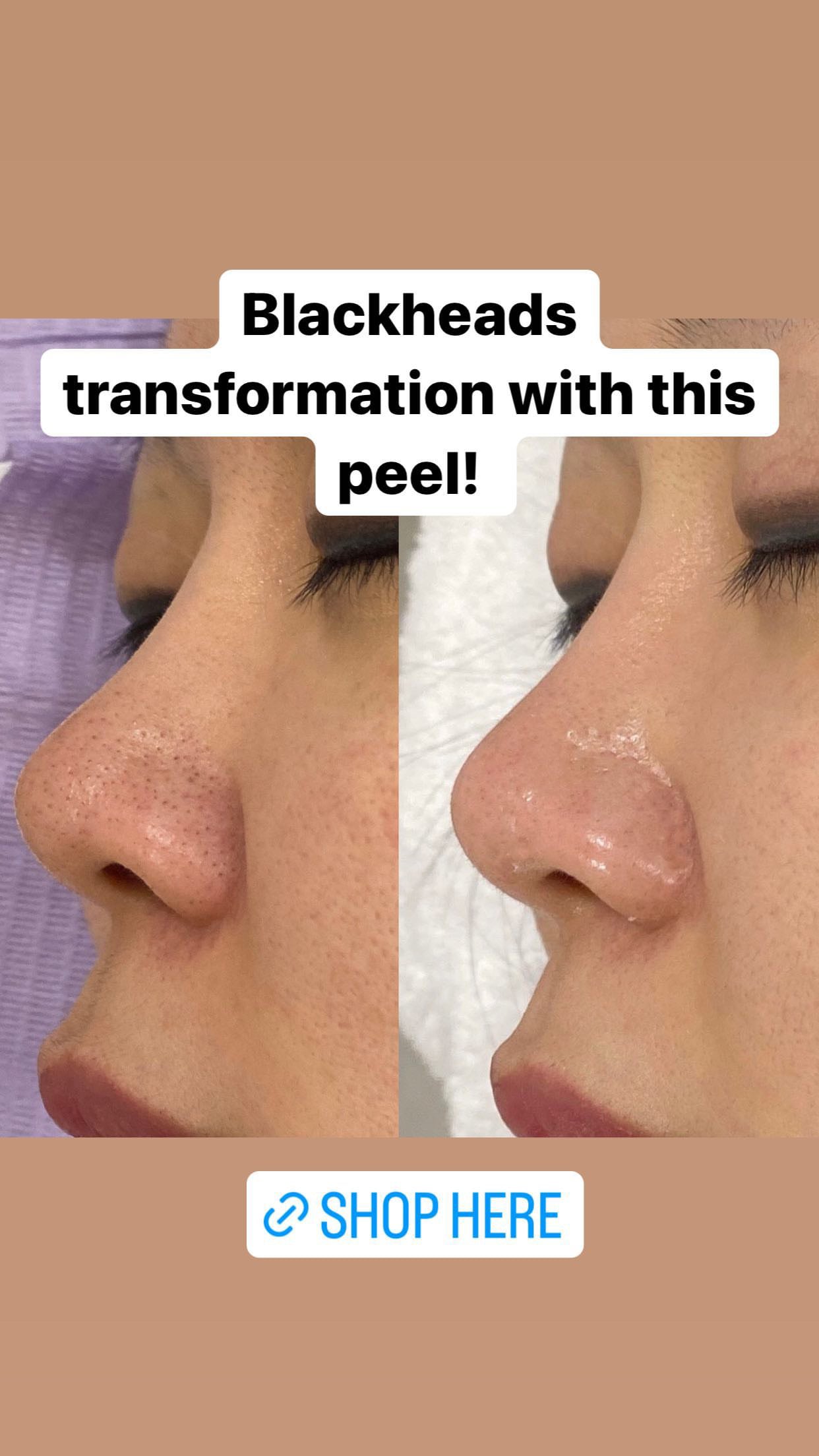 Glass Skin Professional Peel Kit