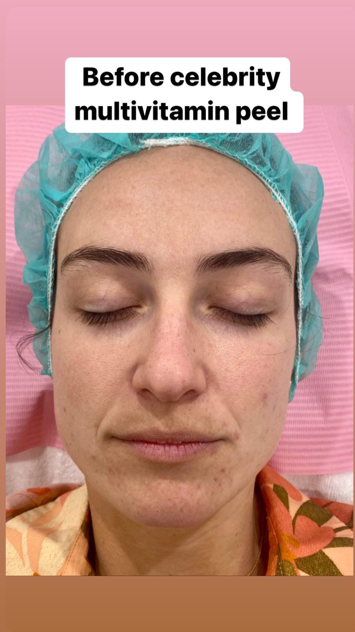 Glass Skin Professional Peel Kit