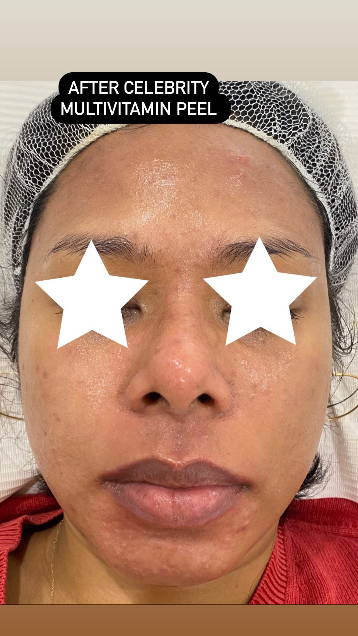 Glass Skin Professional Peel Kit