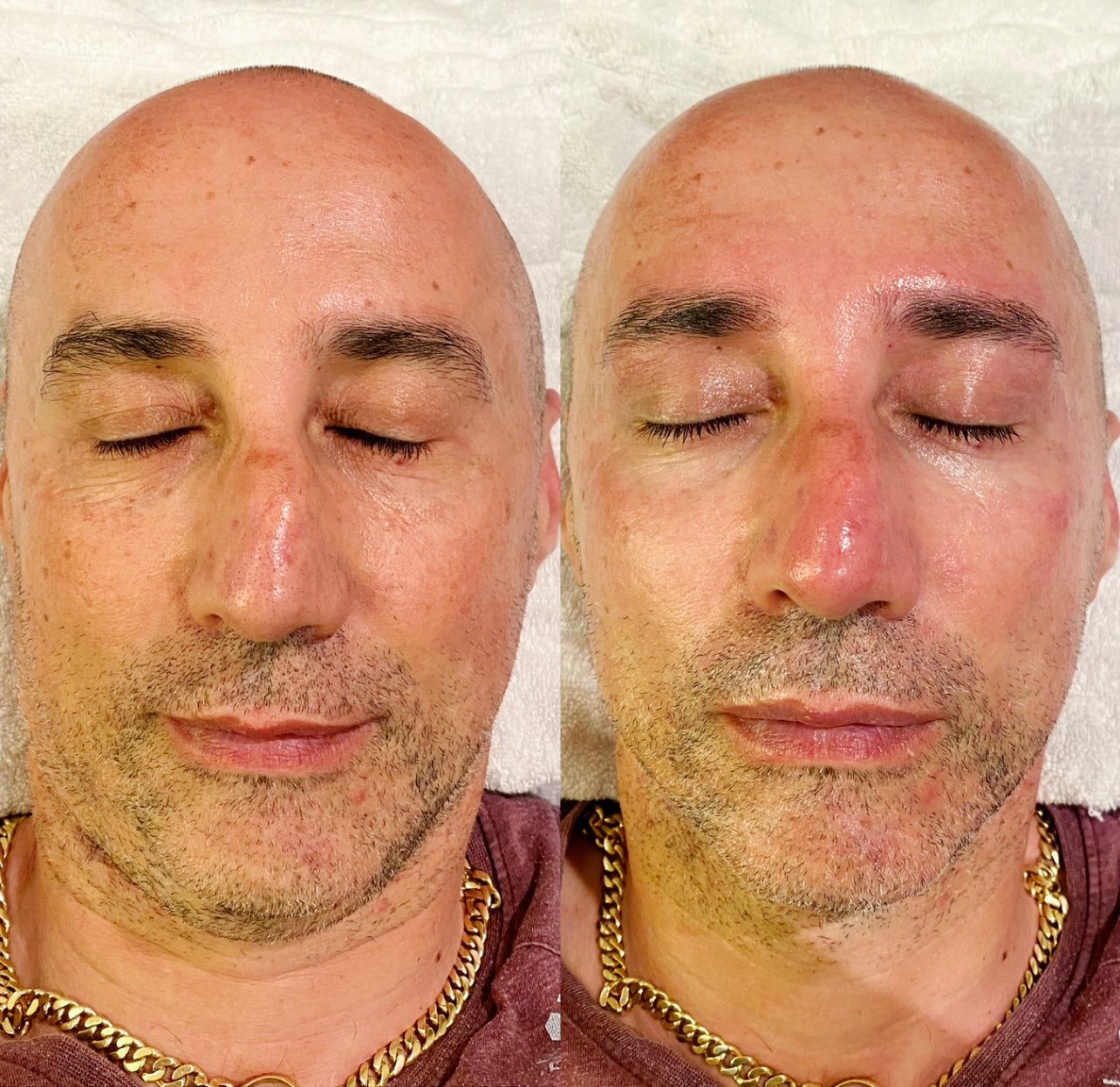 Glass Skin Professional Peel Kit