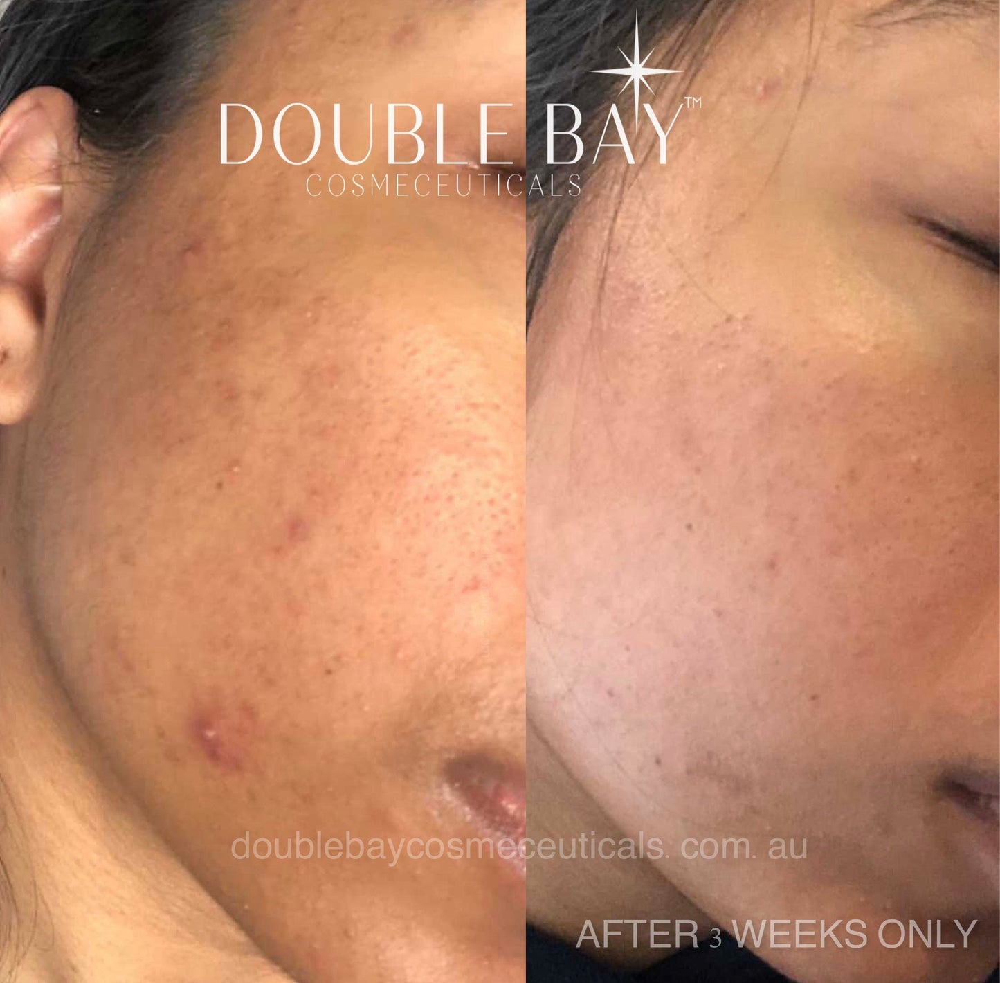 Resilient Pigment+Texture 3x T-Sinase Serum Baby 20ml