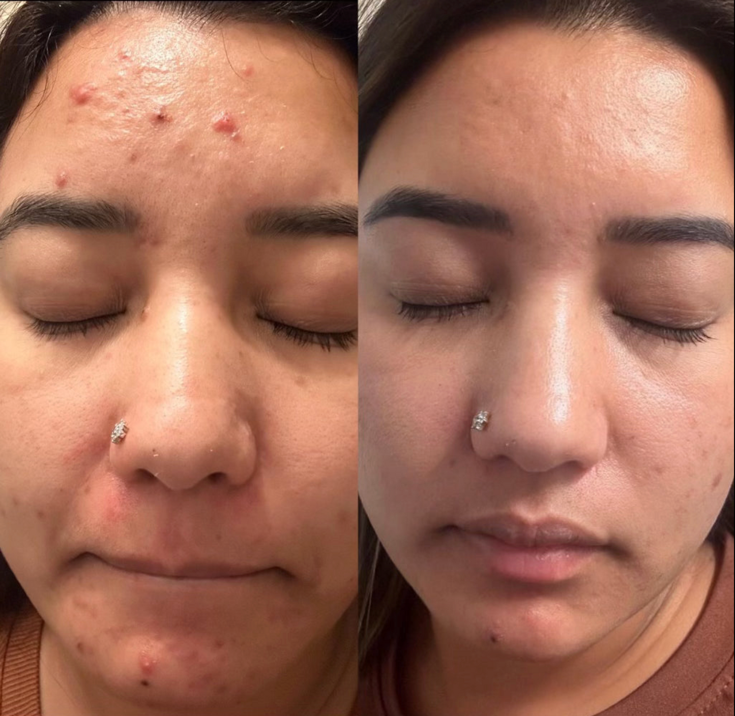 Magical Clinical Calming Peel Cream