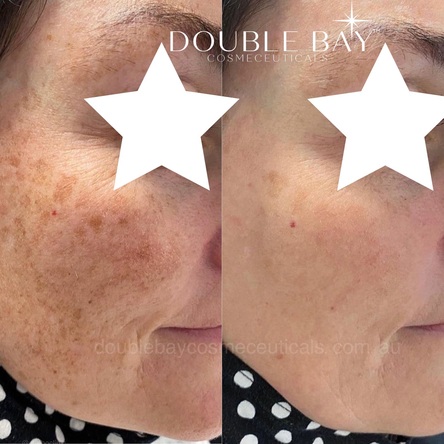 Ubiquinone 2% + LicoriBright Cream