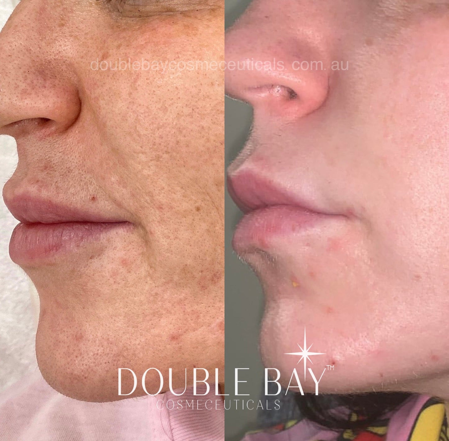 Ubiquinone 2% + LicoriBright Cream