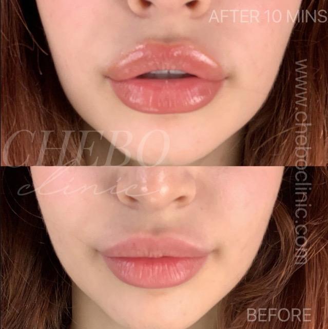 5x Filler Effect Lip Plumper