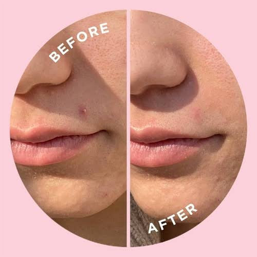 Pimple Patches