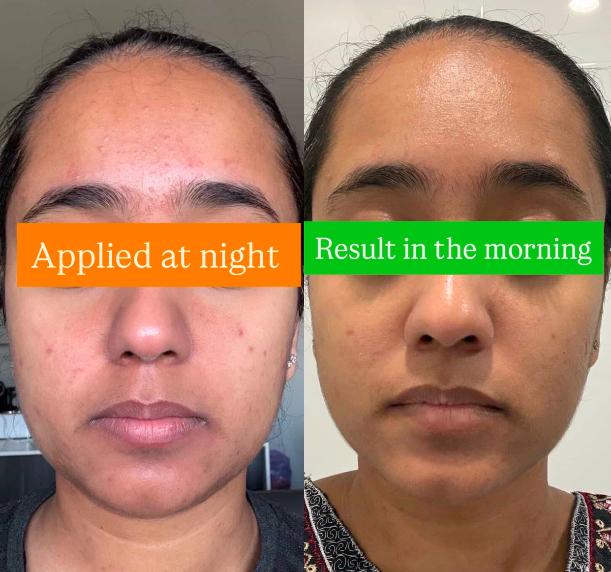 Six-Star Mini Peel Solution Procotol