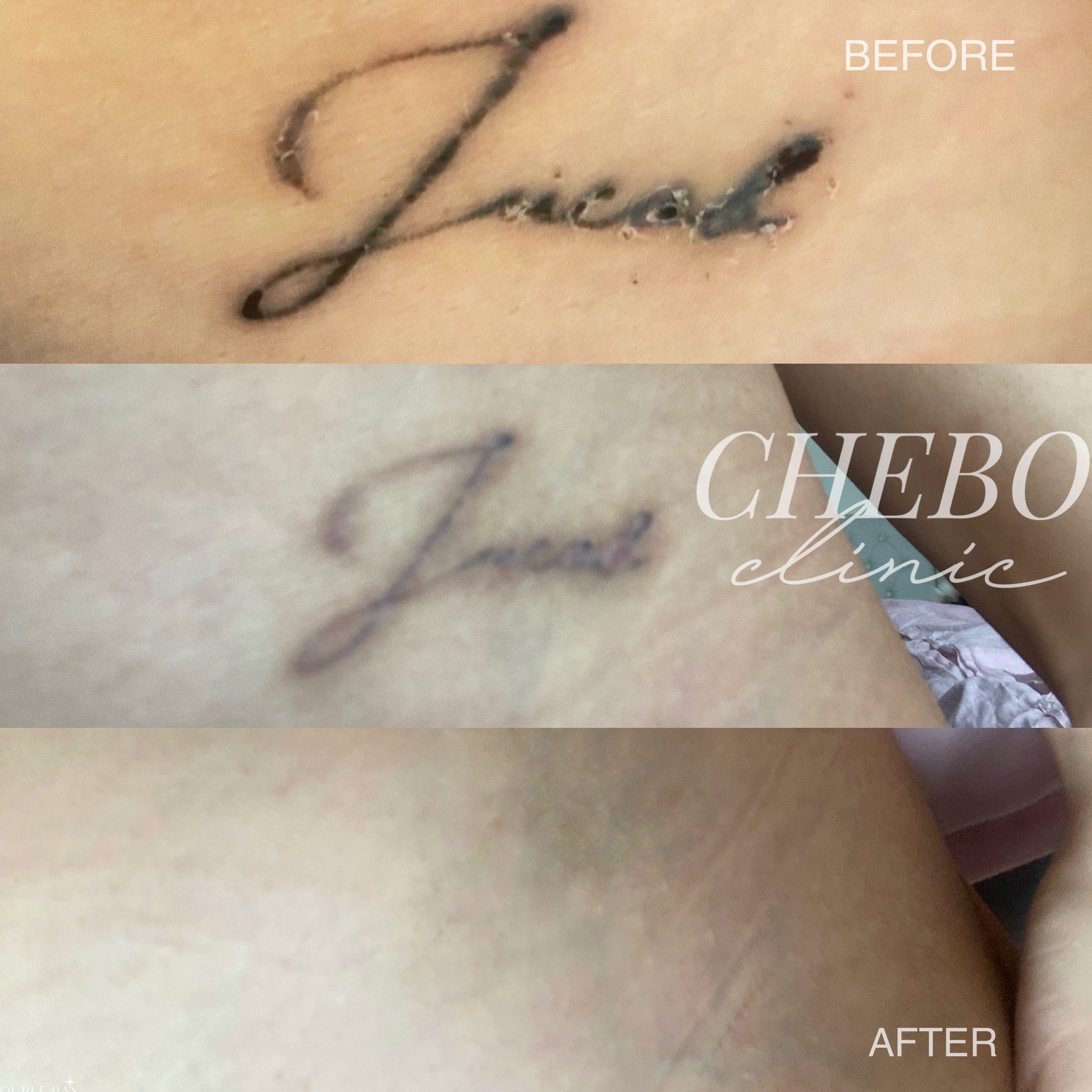 Scar reduction with a fractional laser. One of the first questions people  ask about tattoo removal is will it scar. With a good laser operated by  a... | By Second Skin LaserFacebook